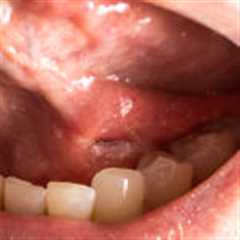 Mouth Cancer: Causes, Symptoms, Prevention and Treatments