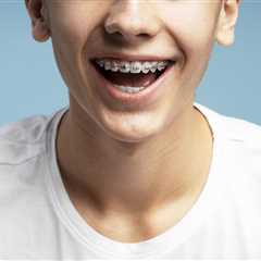 Braces vs. Clear Aligners for Teens in Marietta: Which Is Right for Your Teen?