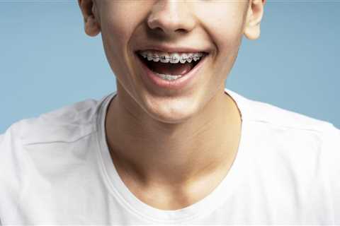 Braces vs. Clear Aligners for Teens in Marietta: Which Is Right for Your Teen?