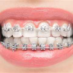 Affordable Braces Options for Teens in Marietta
