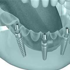 The Role Of A Children's Emergency Dentist In Basel For Young Patients Needing Teeth Implants