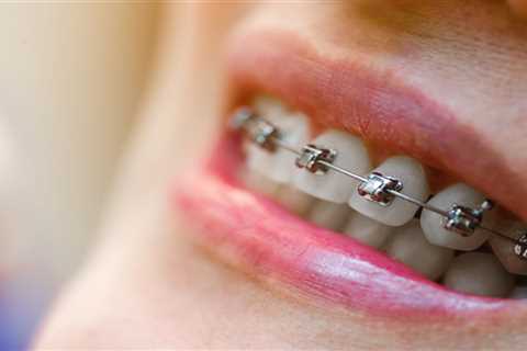 What to Expect After Getting Braces for Your Teen in Marietta