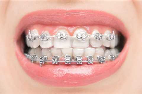 Affordable Braces Options for Teens in Marietta
