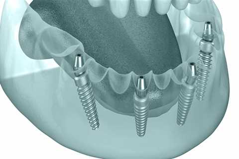 The Role Of A Children's Emergency Dentist In Basel For Young Patients Needing Teeth Implants