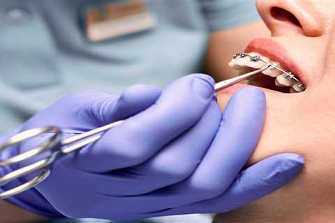 Why Standard Metal Braces Remain a Trusted Choice by Orthodontists