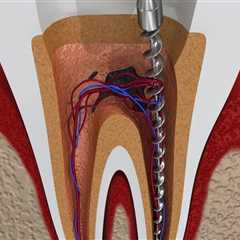 Pain Relief Now: Why An Emergency Dentist Is Key For Necessary Tooth Extraction In Ashburn