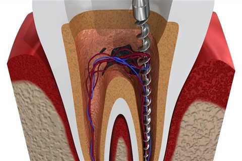 Pain Relief Now: Why An Emergency Dentist Is Key For Necessary Tooth Extraction In Ashburn