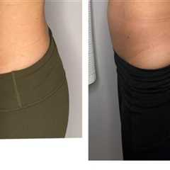 Your Guide To A Slimmer You: The Advantages Of Getting Laser Liposuction At A Trusted Glendale Med..