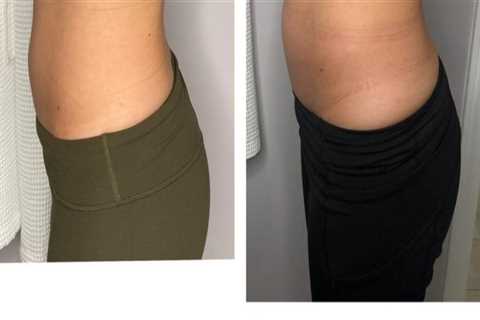 Your Guide To A Slimmer You: The Advantages Of Getting Laser Liposuction At A Trusted Glendale Med..