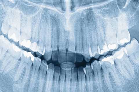 The Role of Dental X-Rays in Orthodontics in Seattle