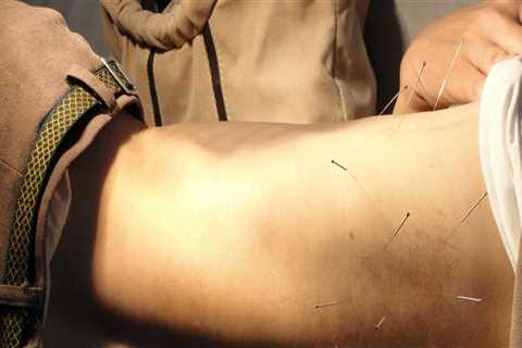 Discover Electroacupuncture Benefits in Portland