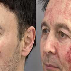 Understanding Downtime and Recovery in Medical Aesthetic Treatments