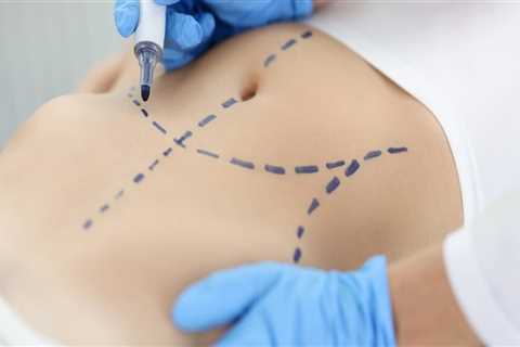 Enhance Comfort and Confidence: Liposuction for Back Injuries