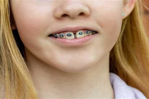 Are Metal Braces Right for Your Child? A Parent’s Guide