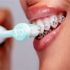 Teeth Cleaning with Braces: What You Need to Know